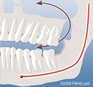 After Wisdom Tooth Removal